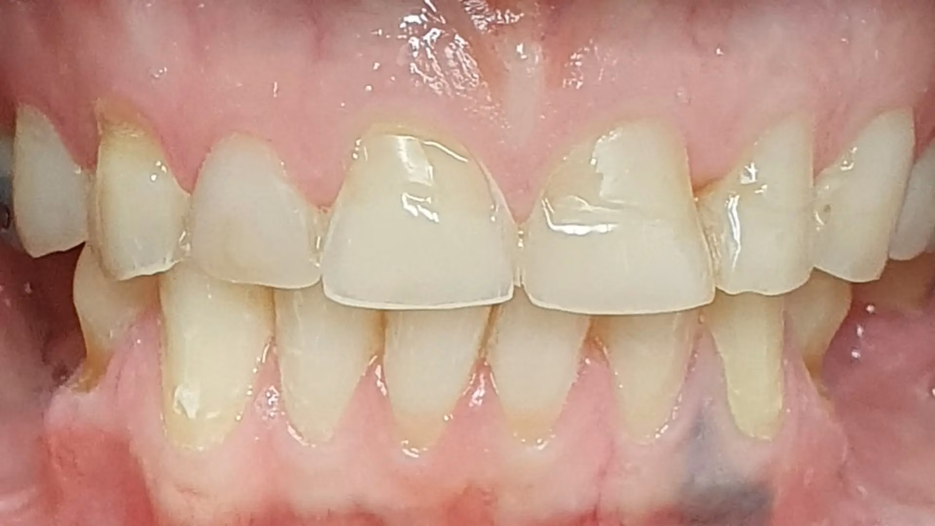 Sourire avant soin 8