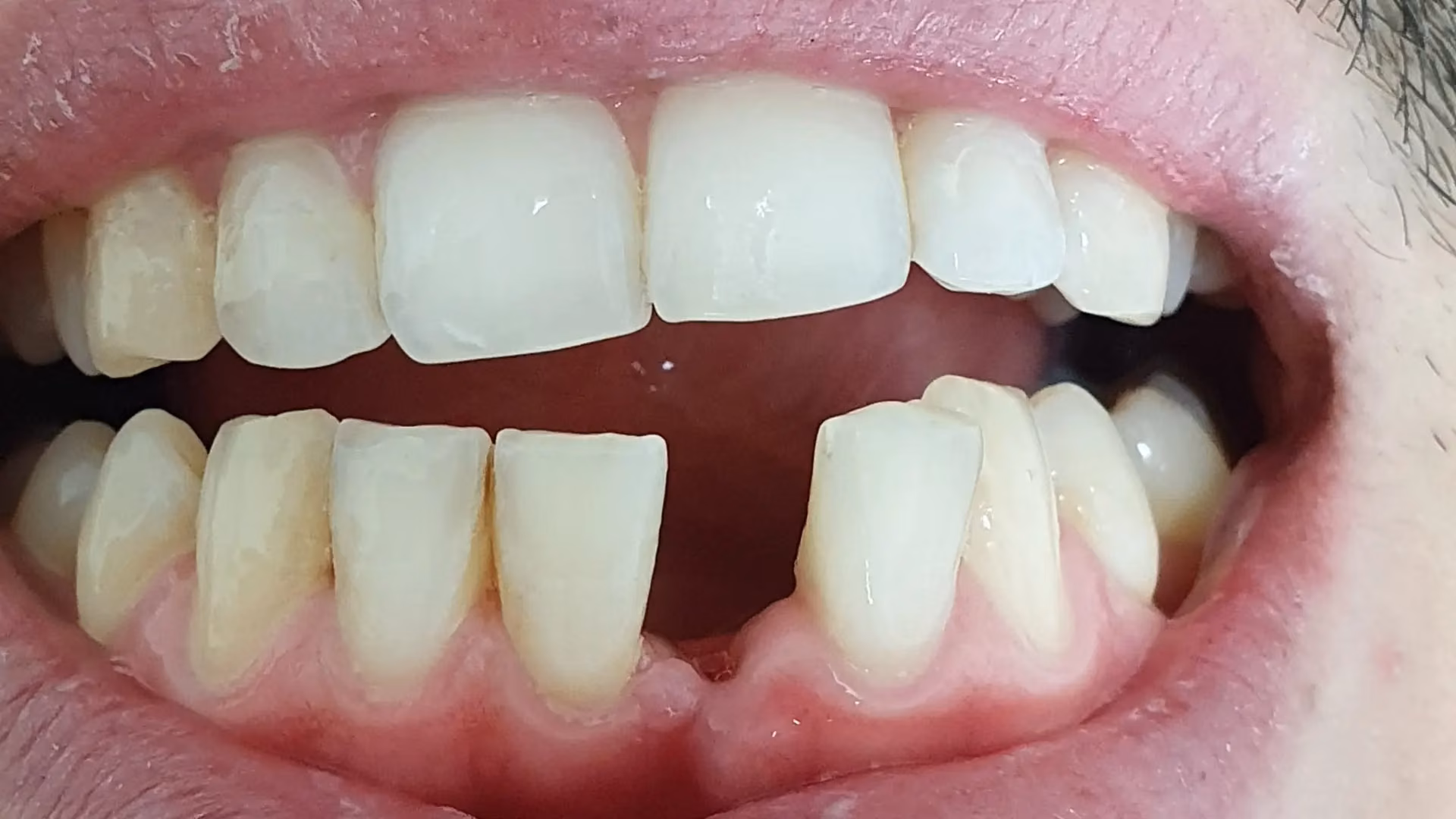 Sourire avant soin 9