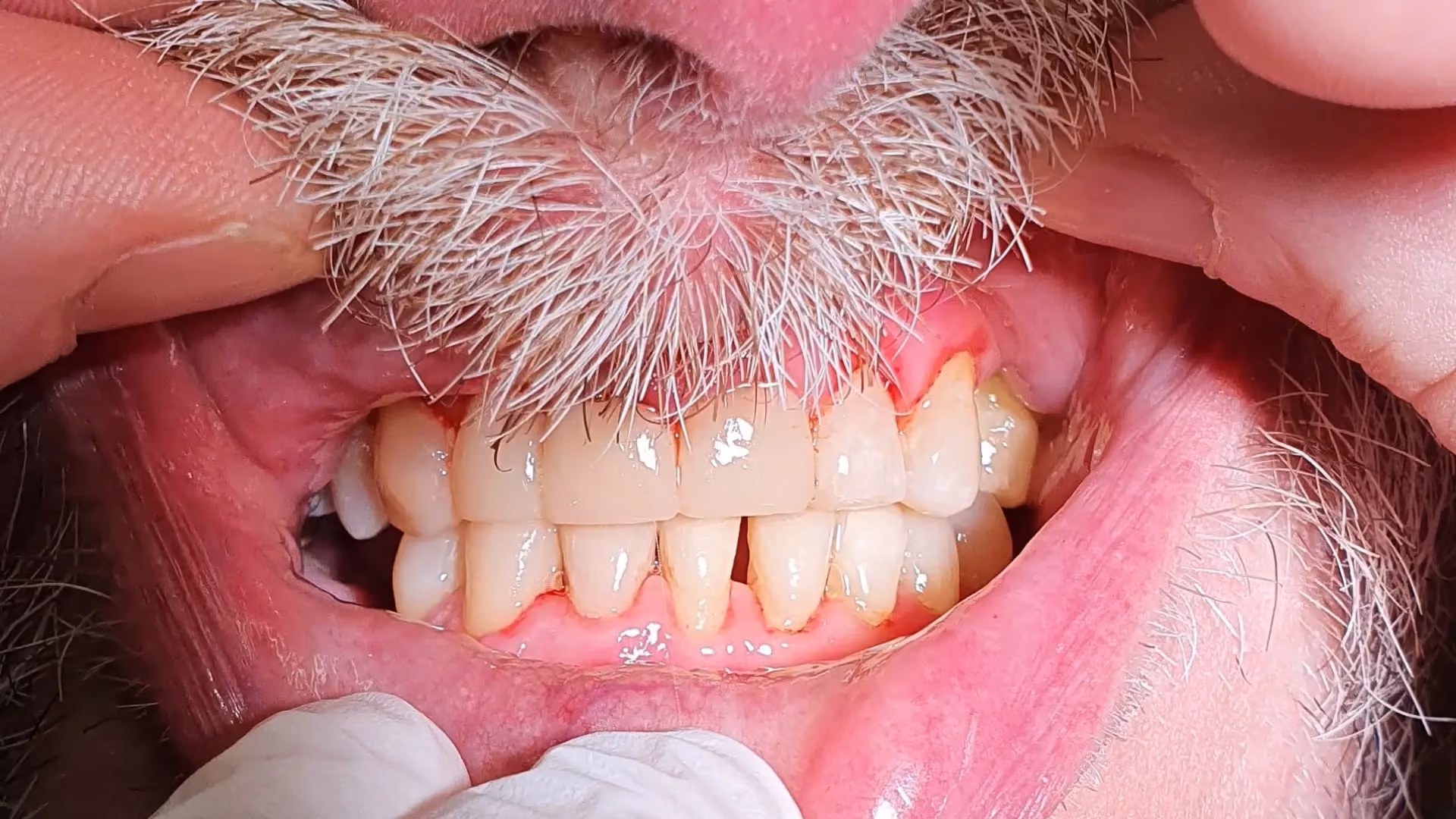 Sourire après soin 1