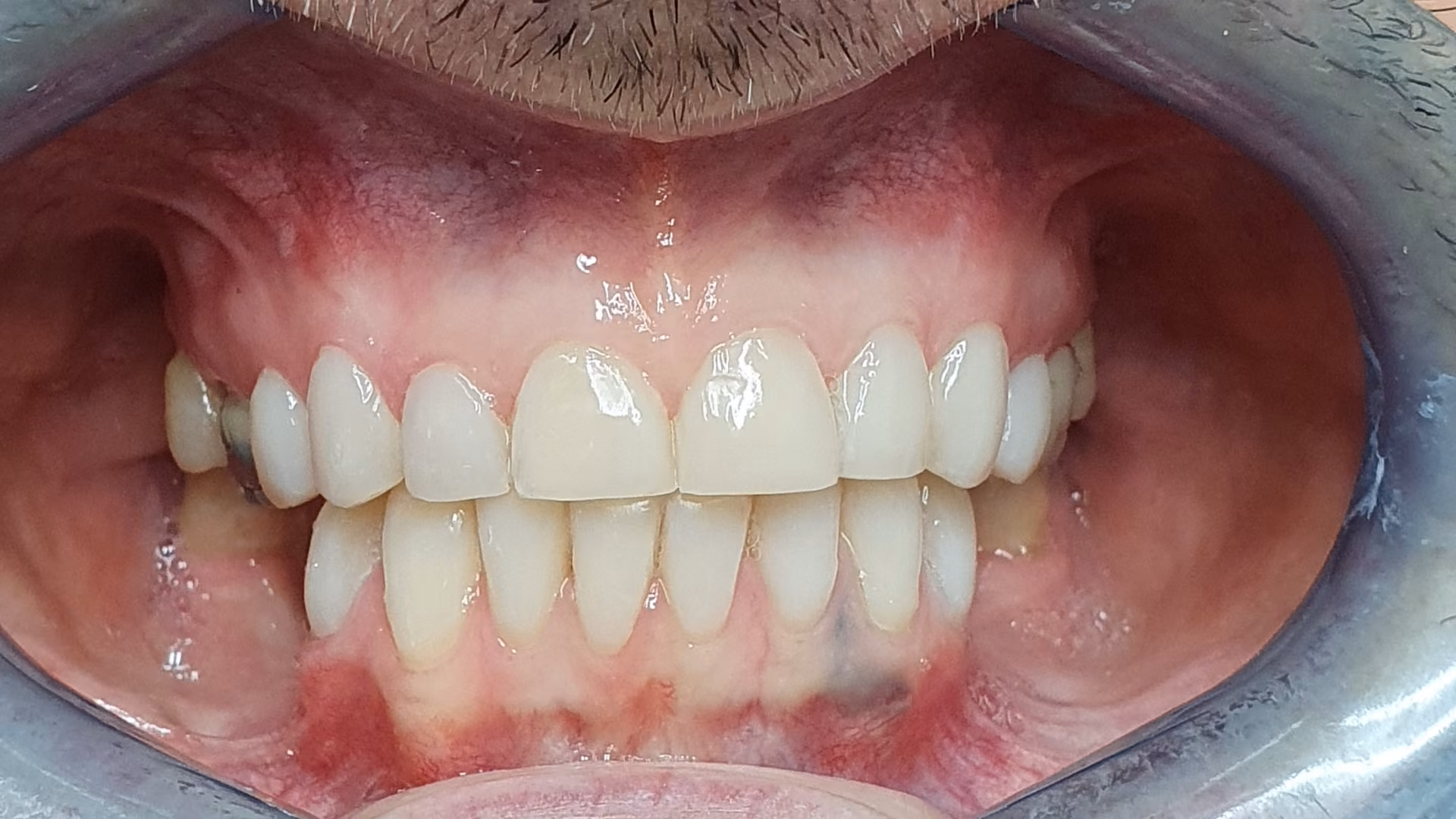 Sourire après soin 11