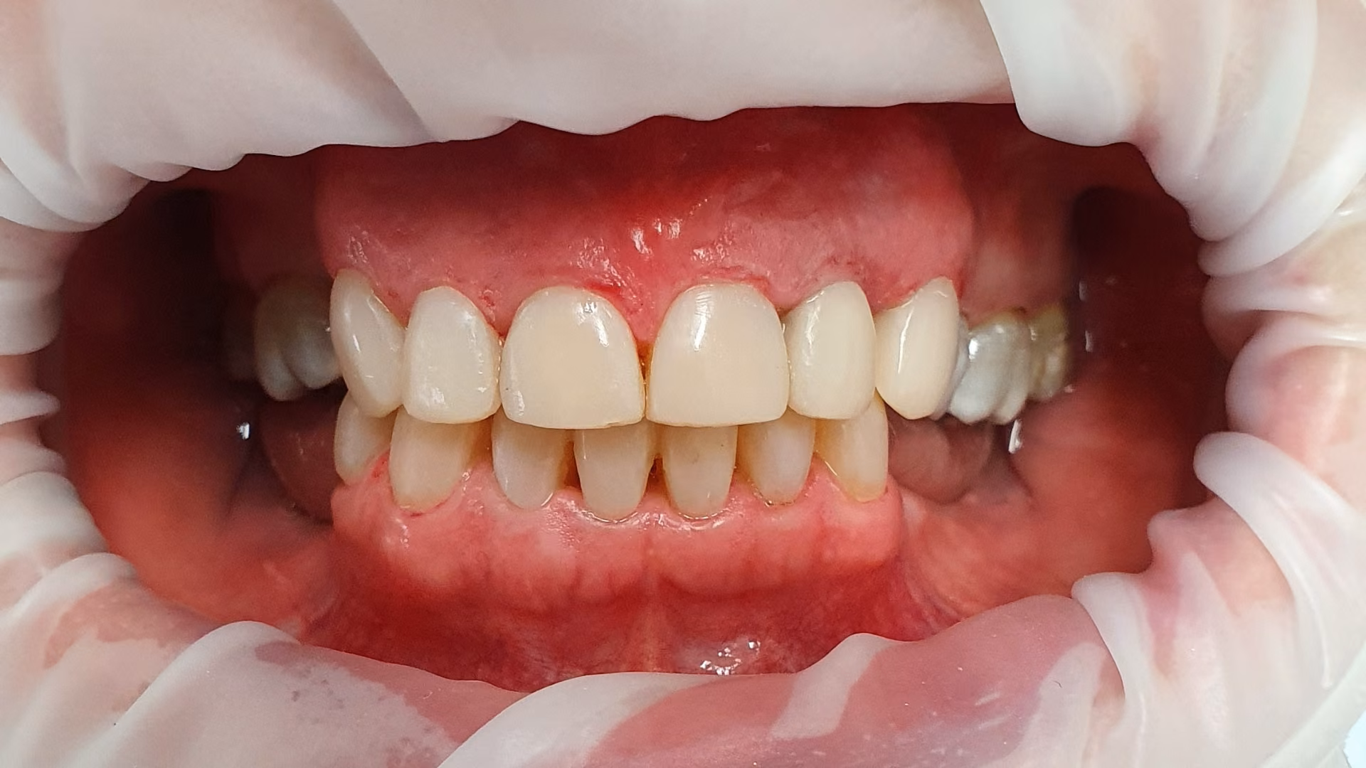 Sourire après soin 4